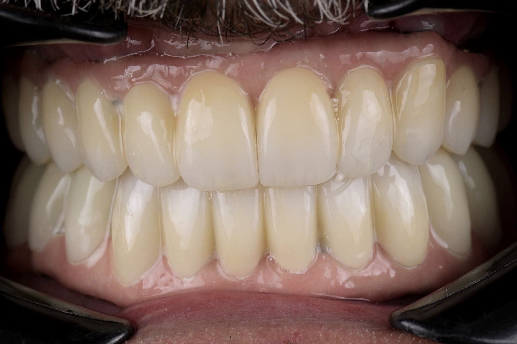 Réhabilitation complète sur implants posée, vue de face