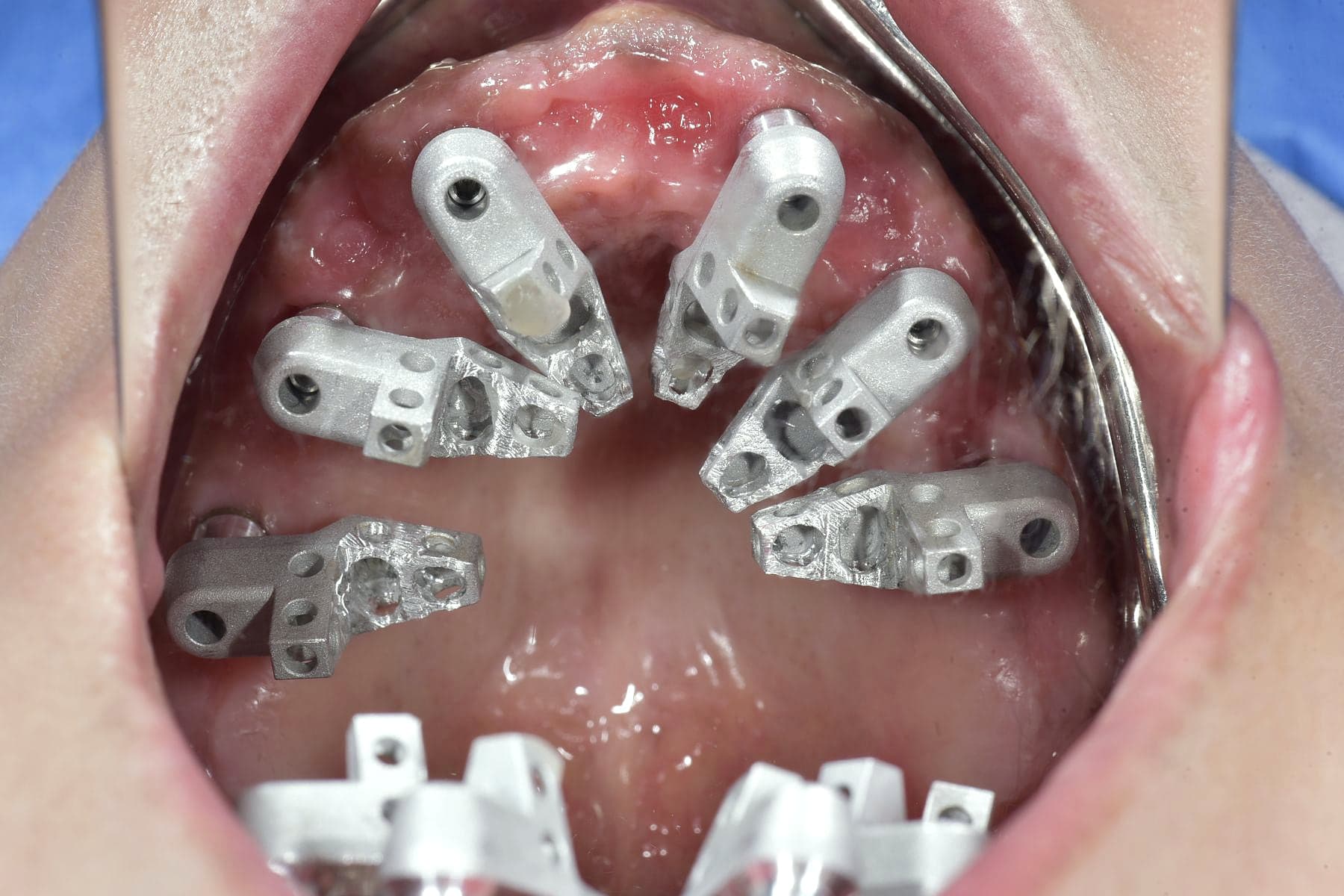 Guide chirurgical utilisé pour poser les implants avec précision