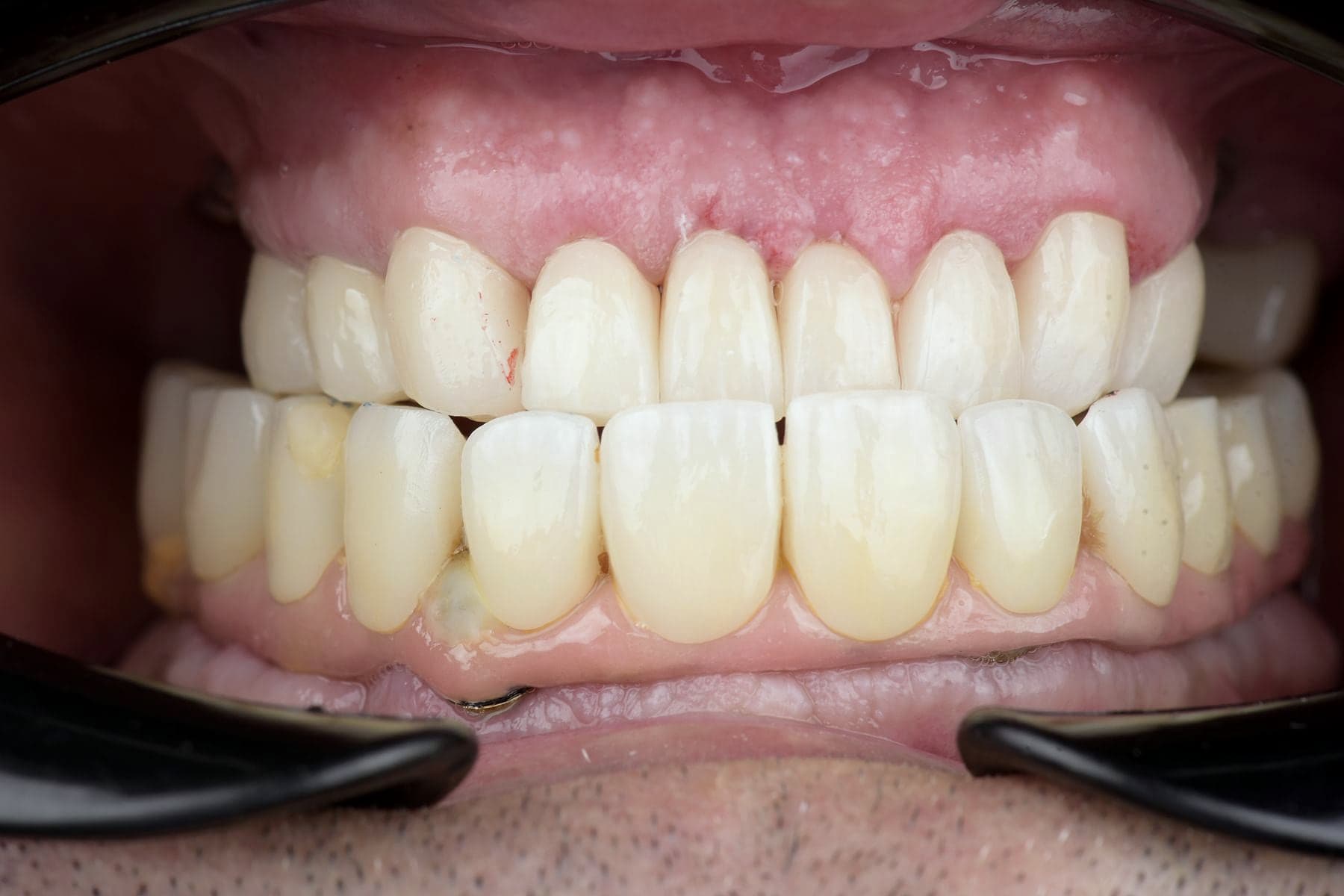Réhabilitation complète sur implants posée, vue de face