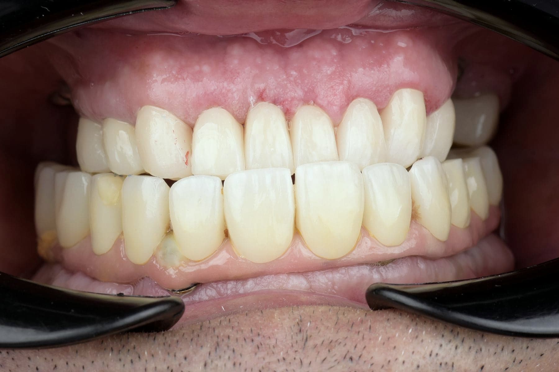 Réhabilitation complète sur implants posée, vue de face