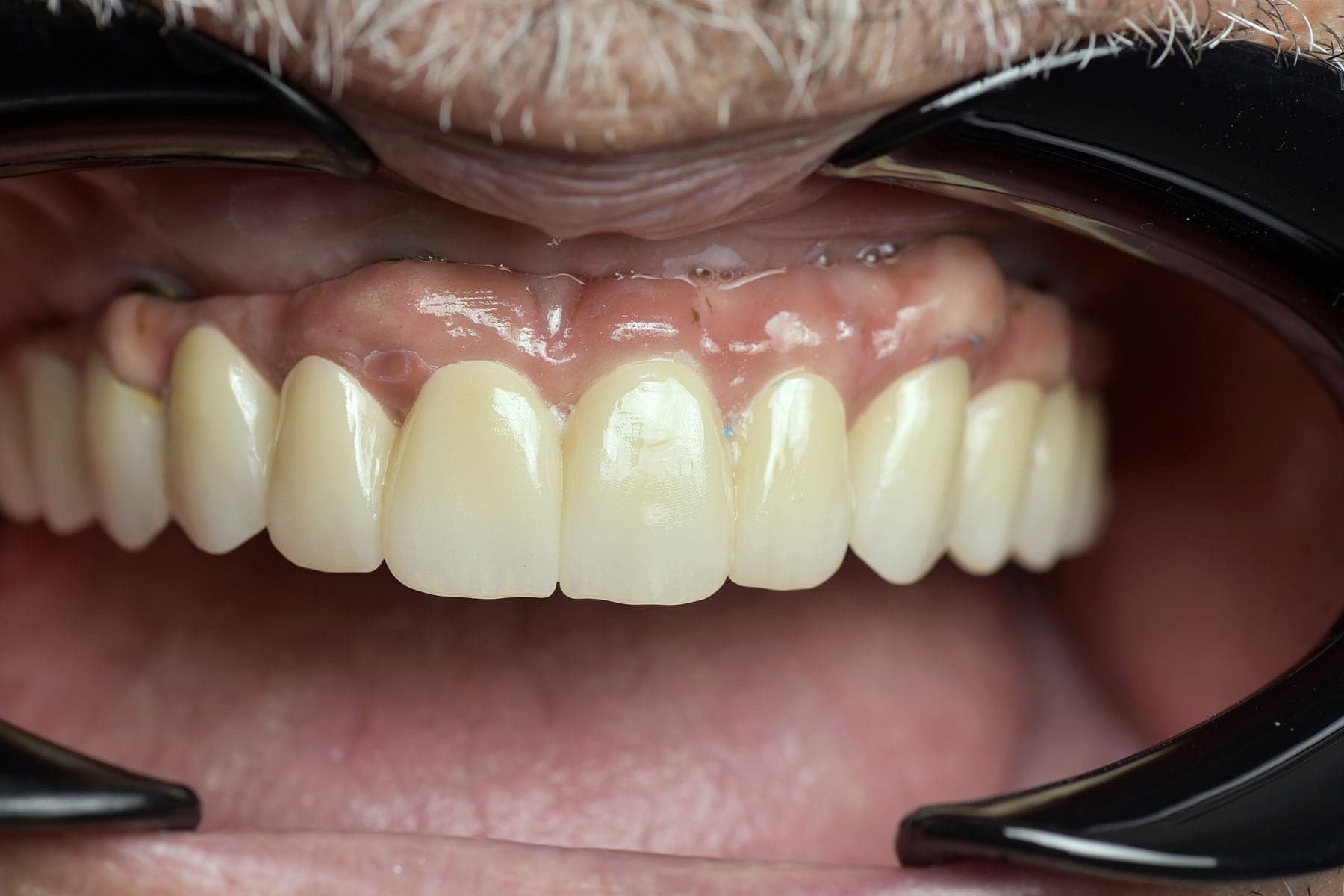 Réhabilitation complète sur implants posée, vue de face