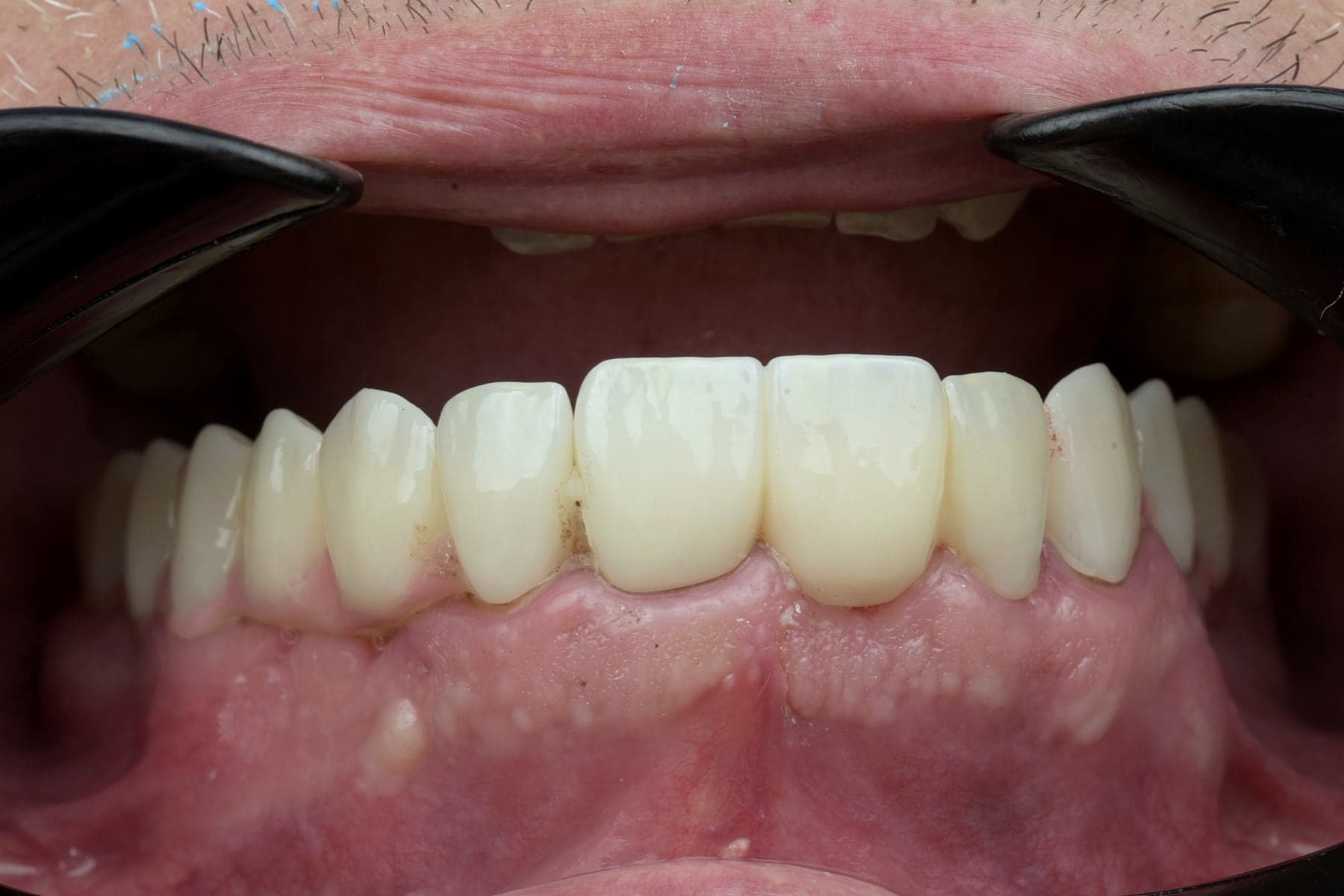 Réhabilitation complète sur implants posée, vue de face