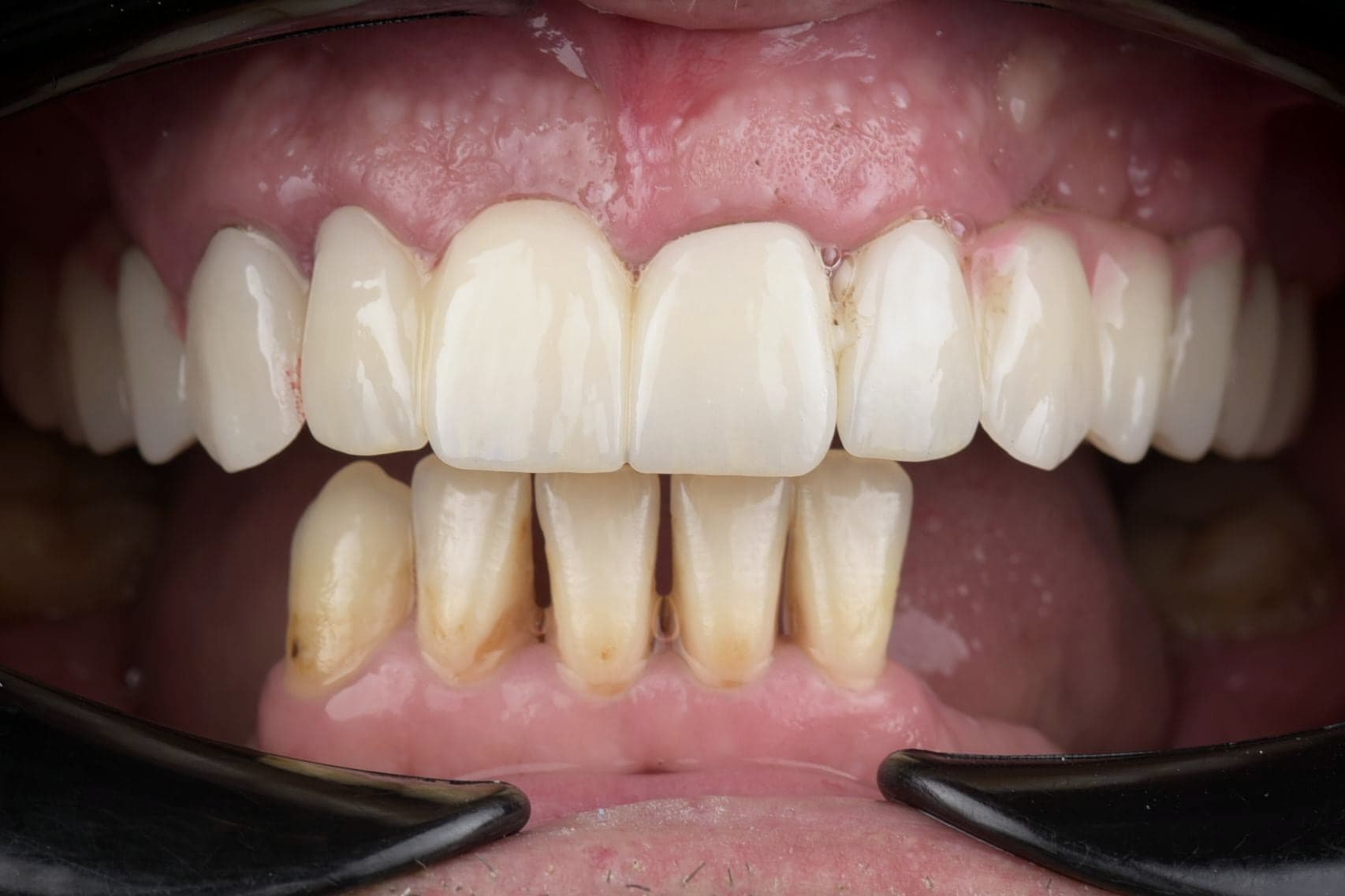 Réhabilitation complète sur implants posée, vue de face