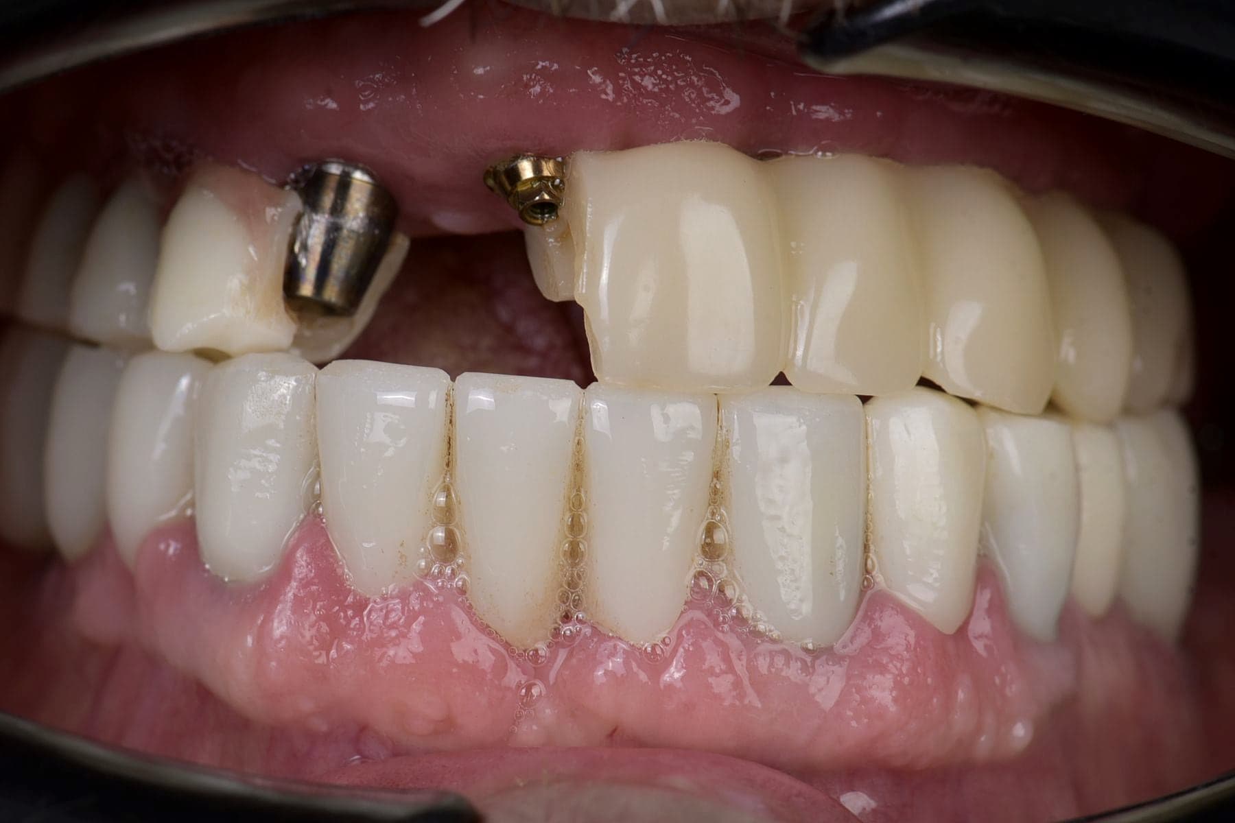 Piliers implantaires en bouche avant la pièce définitive