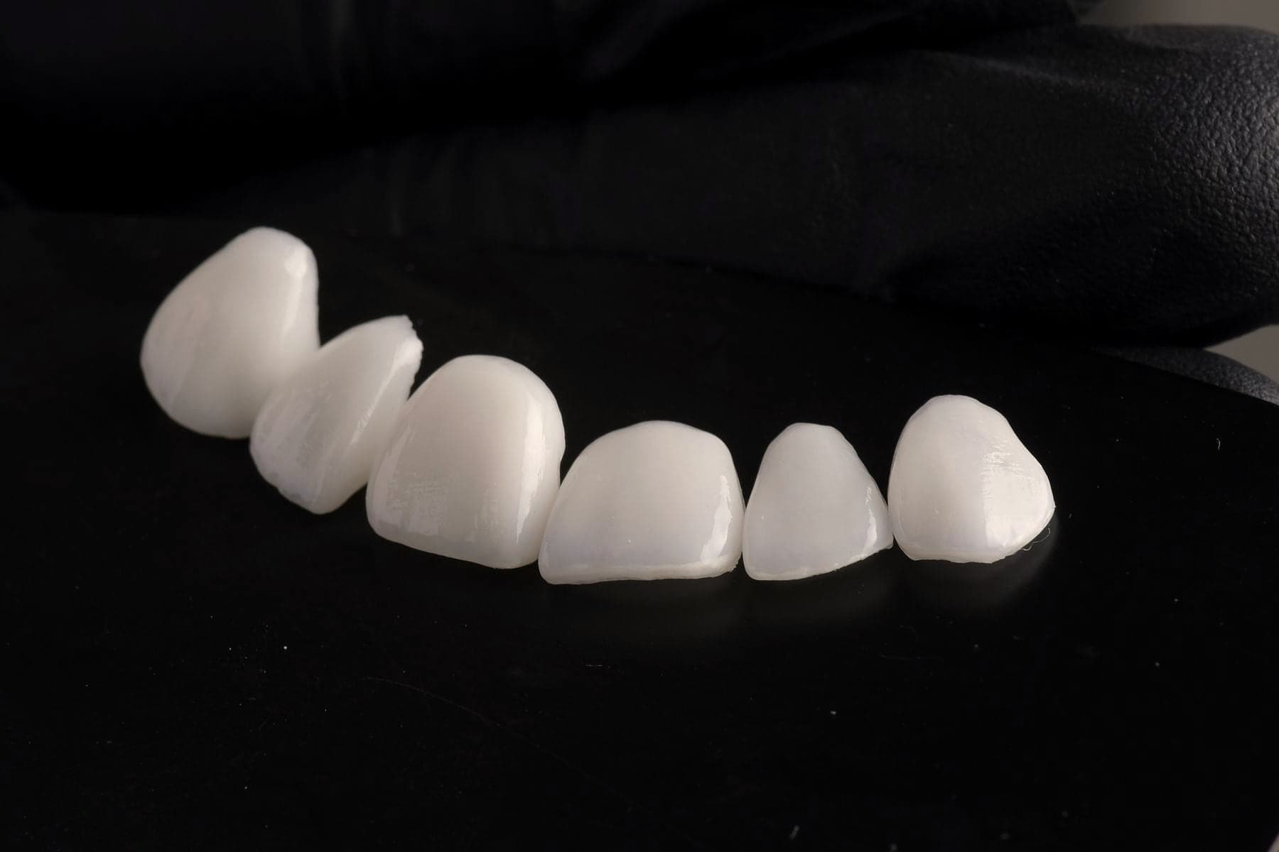 Facettes en céramique fabriquées par le laboratoire, prêtes à être posées