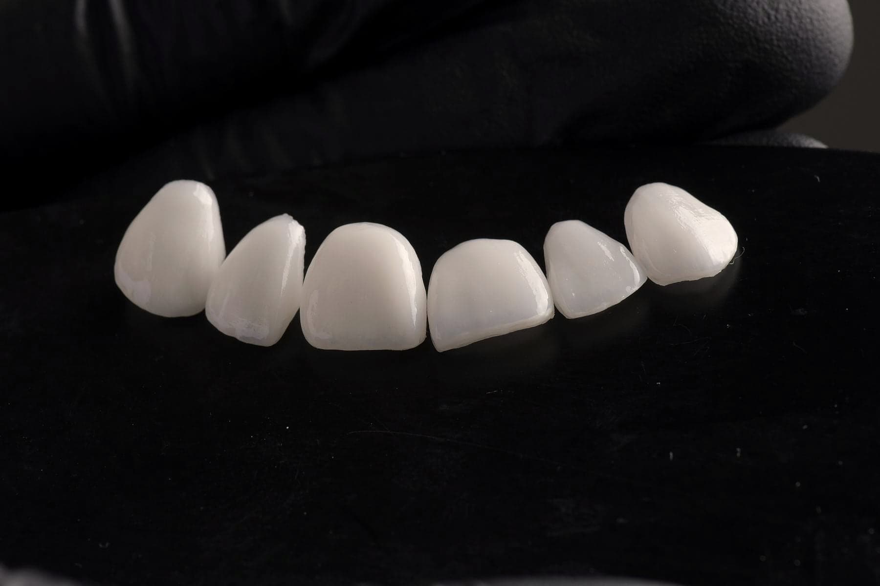 Facettes en céramique fabriquées par le laboratoire, prêtes à être posées