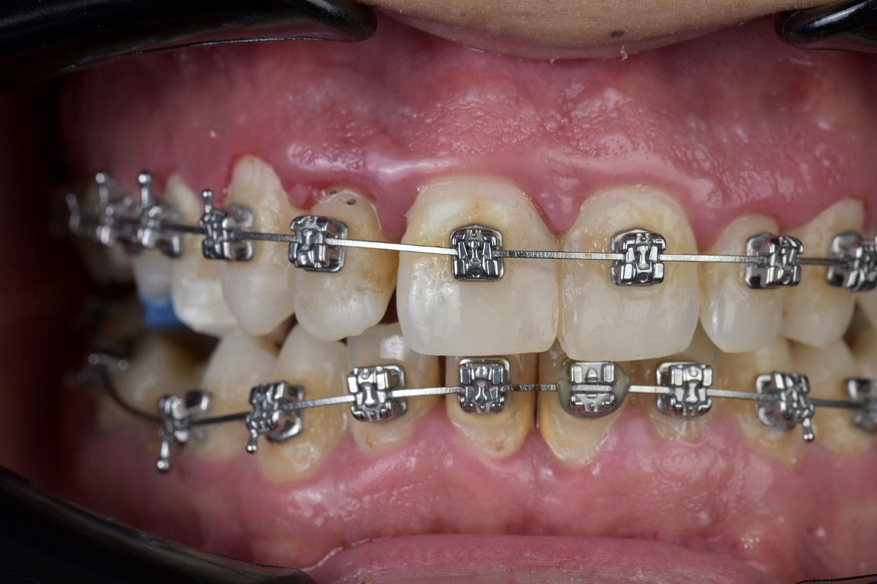 Appareil orthodontique fixe en cours de traitement