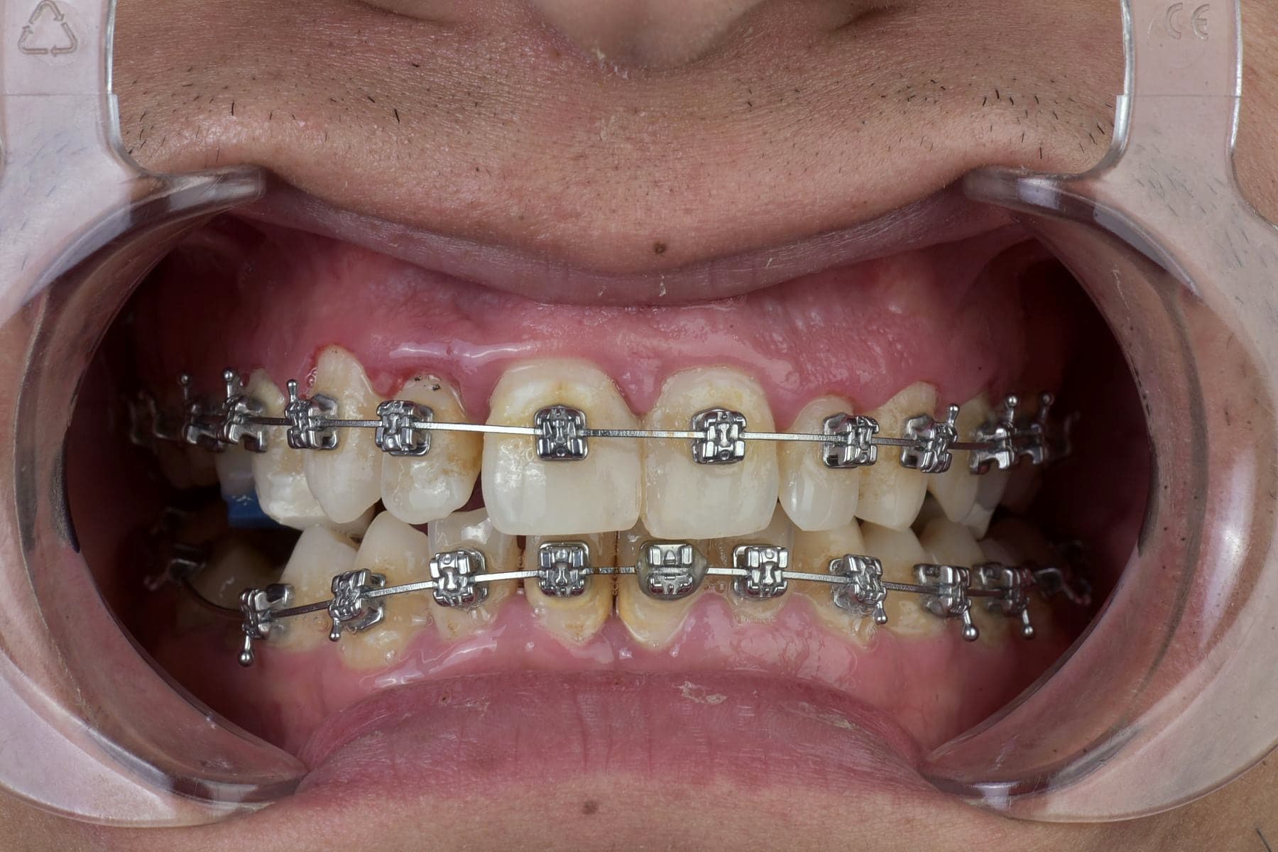 Appareil orthodontique fixe en cours de traitement