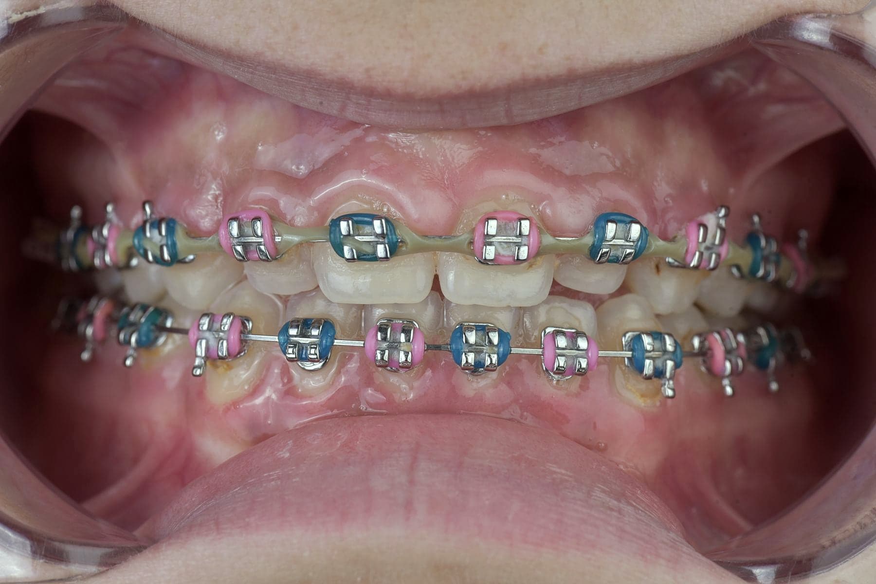 Appareil orthodontique fixe en cours de traitement