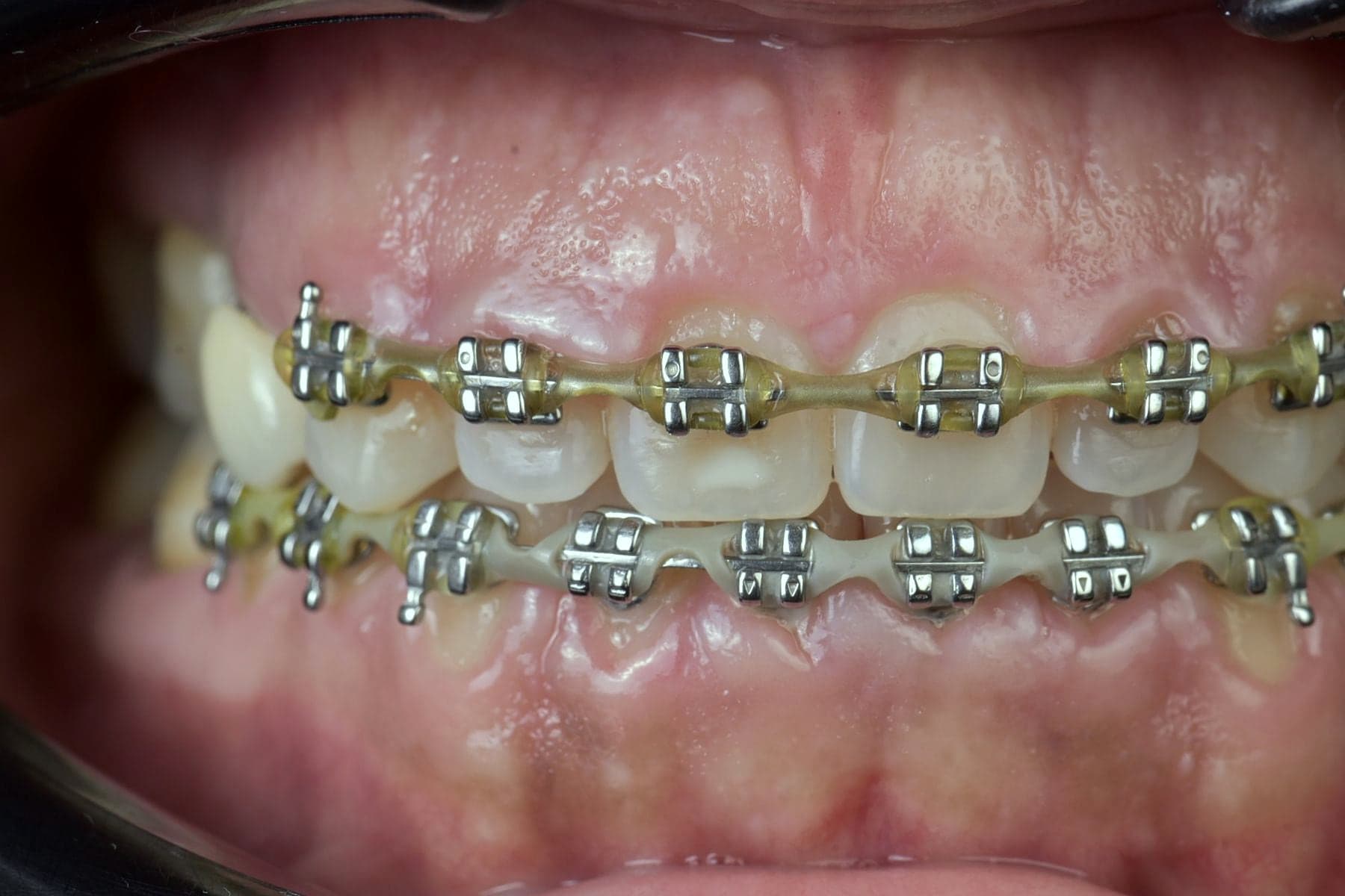 Appareil orthodontique fixe en cours de traitement