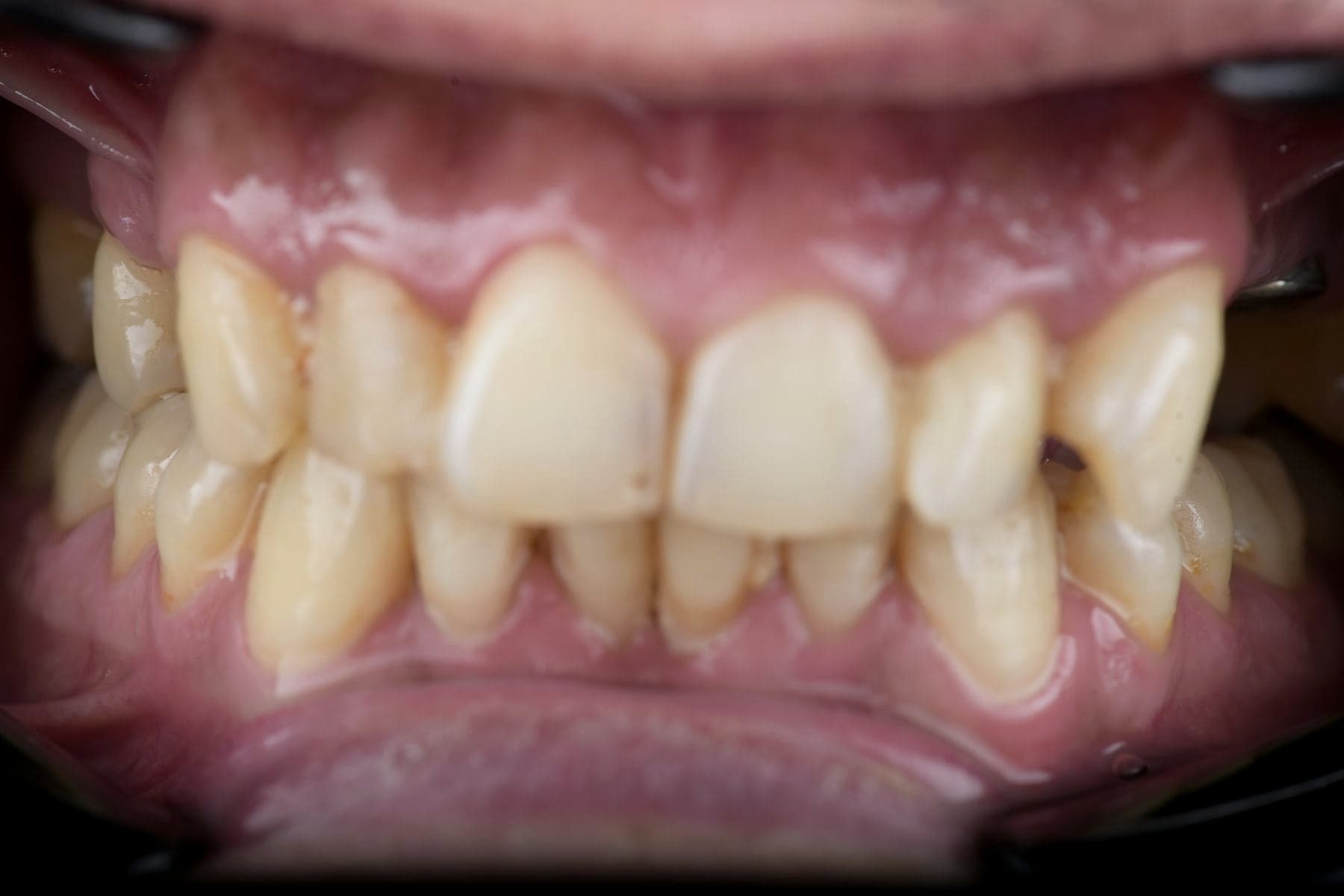 Dents avant une restauration esthétique en céramique