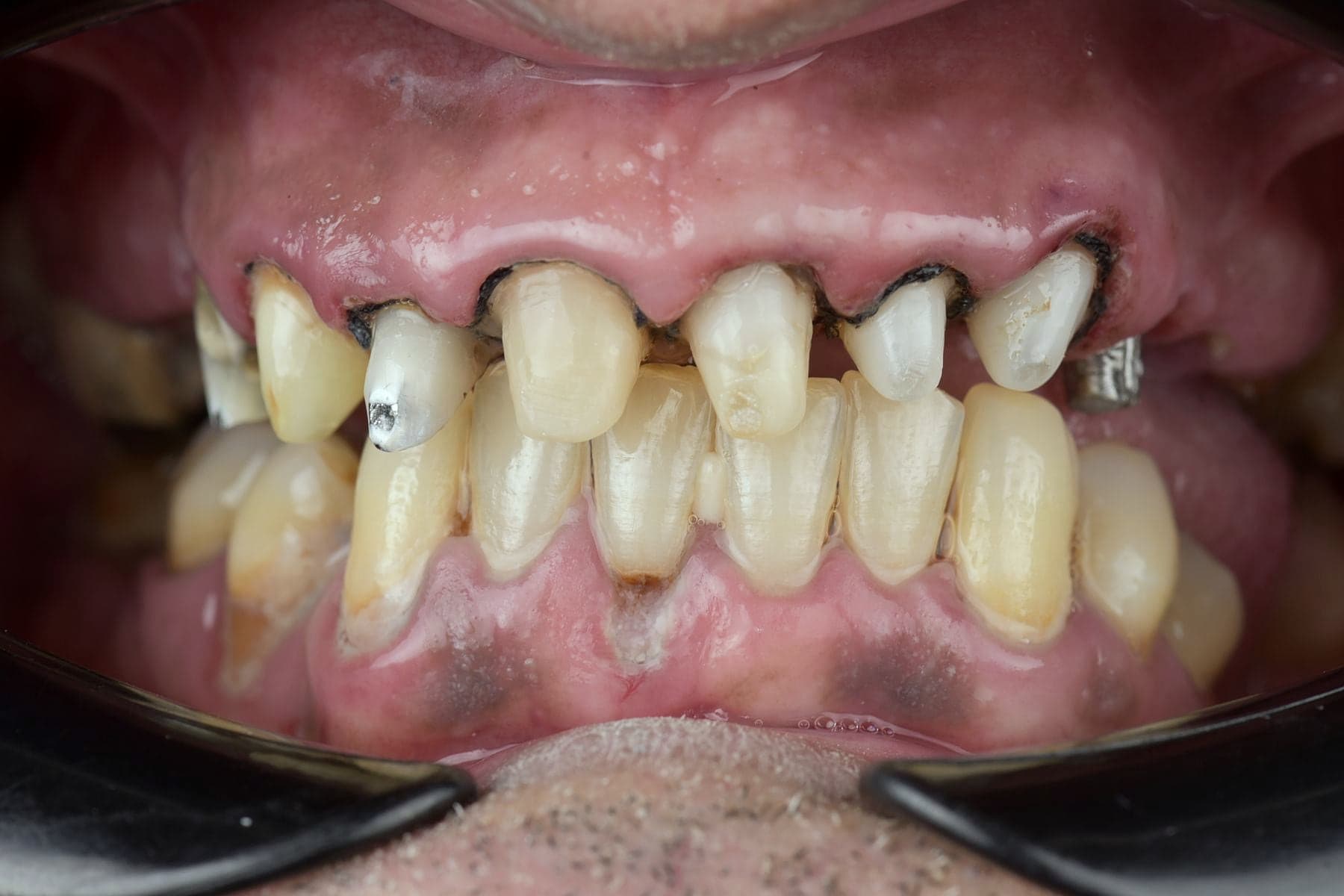 Dents avant une restauration esthétique en céramique